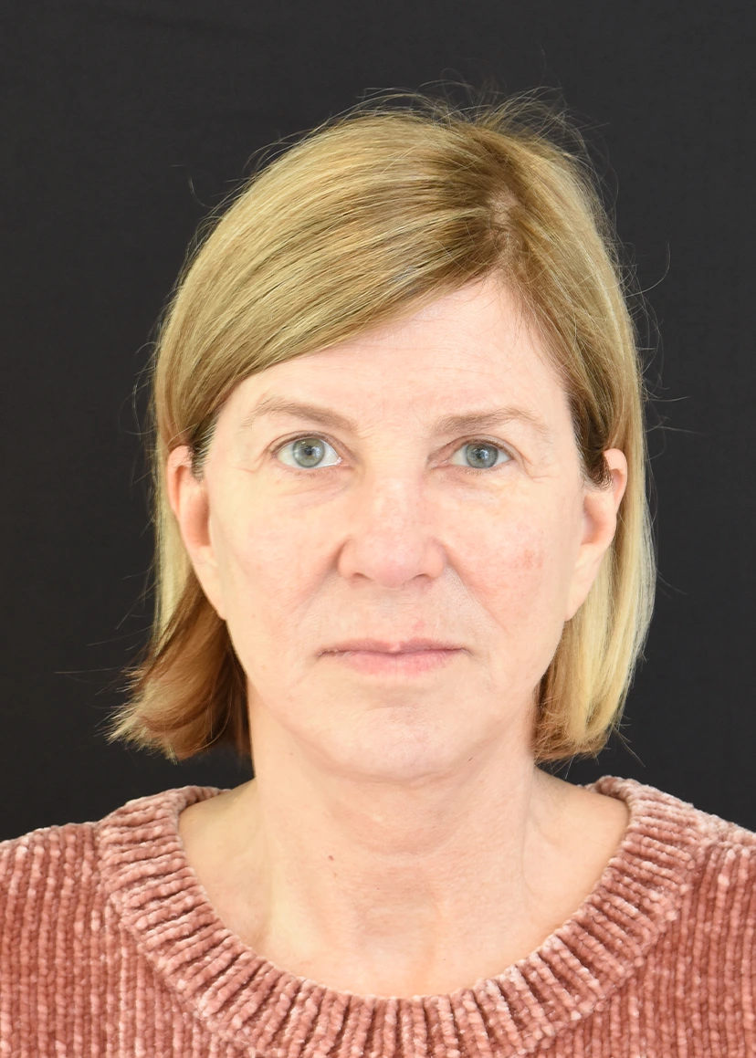 Deep Plane Facelift Patient 28 Set 1 After