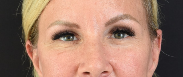 Brow Lift Patient 18 Set 1 After
