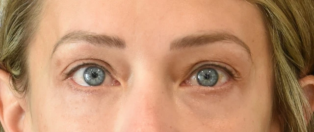 Eyelid Surgery Patient 24 Set 1 After