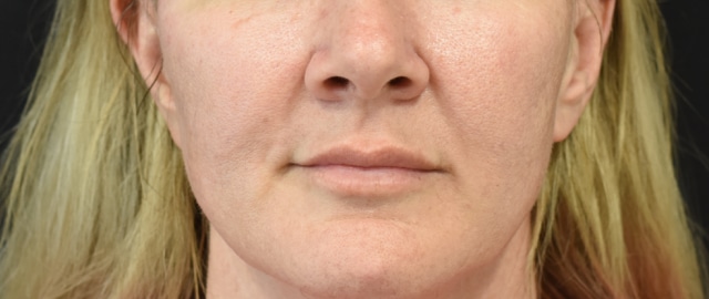 Lip Lift Patient 18 Set 1 Before
