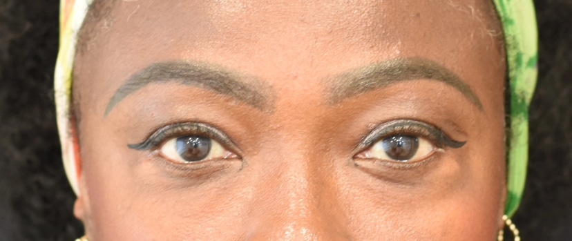 Eyelid Surgery Patient 5 Set 1 After