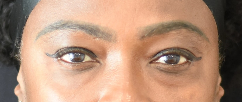 Eyelid Surgery Patient 5 Set 1 Before